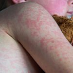 With over 900 US measles cases so far this year, things are looking bleak